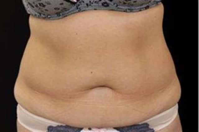 EMSCULPT NEO Before & After Case 350 before