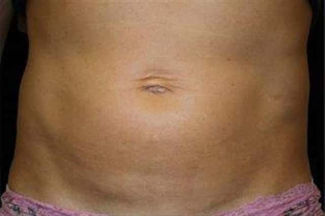 EMSCULPT NEO Before & After Case 351 after