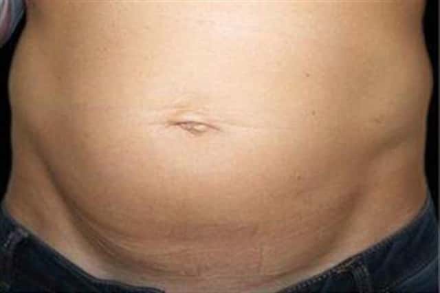 EMSCULPT NEO Before & After Case 351 before