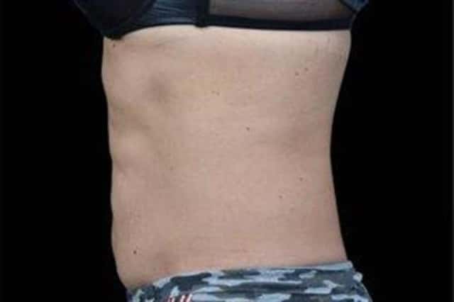 EMSCULPT NEO Before & After Case 352 after