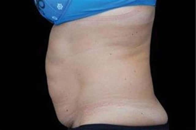EMSCULPT NEO Before & After Case 352 before