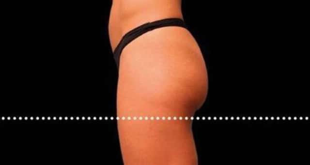 EMSCULPT NEO Before & After Case 353 after