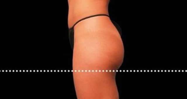 EMSCULPT NEO Before & After Case 353 before
