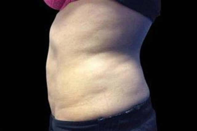 EMSCULPT NEO Before & After Case 355 after