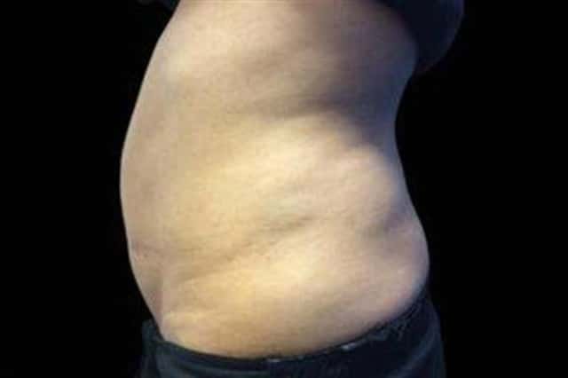 EMSCULPT NEO Before & After Case 355 before