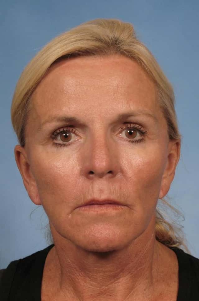 Eyelid Lift (Blepharoplasty) Before & After Case 106 after
