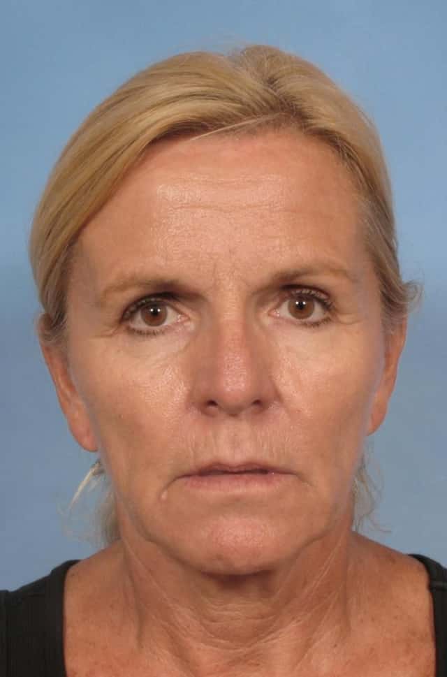 Eyelid Lift (Blepharoplasty) Before & After Case 106 before