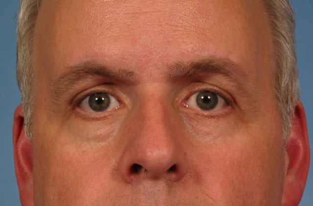 Eyelid Lift (Blepharoplasty) Before & After Case 175 after