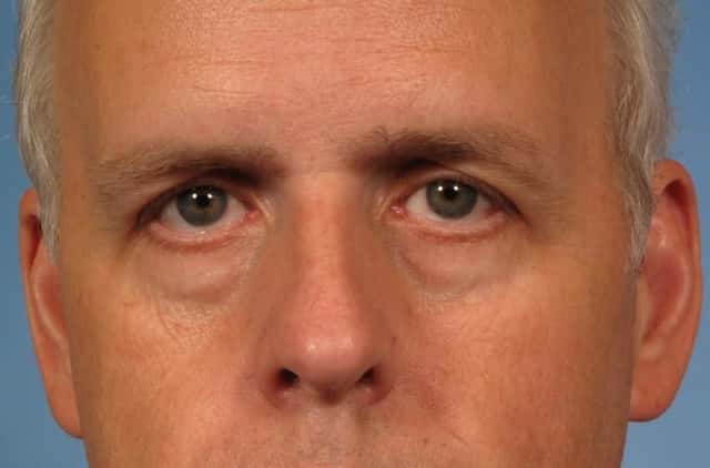 Eyelid Lift (Blepharoplasty) Before & After Case 175 before