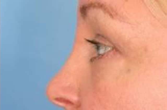 Eyelid Lift (Blepharoplasty) Before & After Case 18 after