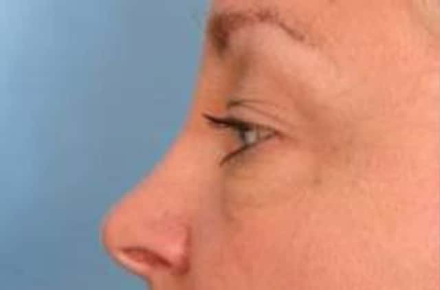 Eyelid Lift (Blepharoplasty) Before & After Case 18 before