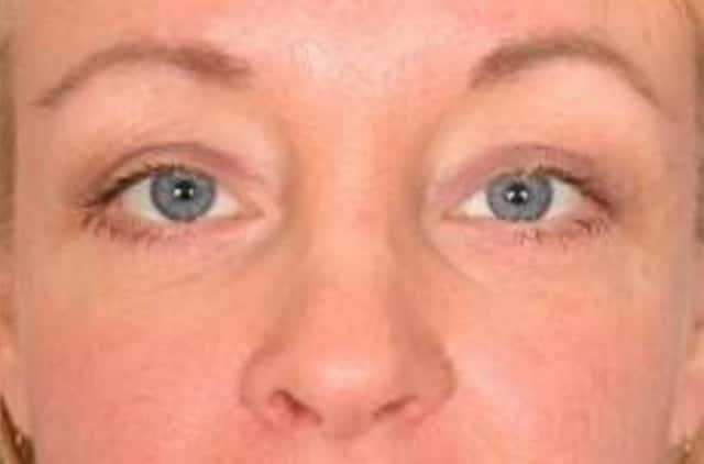 Eyelid Lift (Blepharoplasty) Before & After Case 18 after