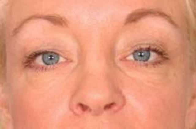 Eyelid Lift (Blepharoplasty) Before & After Case 18 before