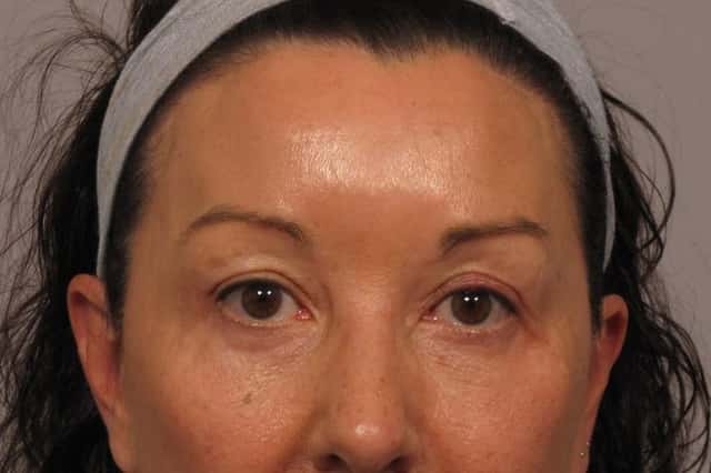 Before and After 9 months from Eyelid lift and Brow Lift