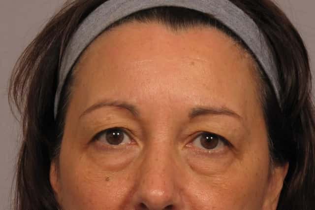 Front View of Patient who underwent eyelid lift and brow lift