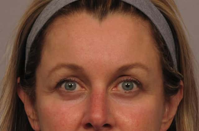 Before and 6 Months After Eye lid Lift and Brow Lift, Front View