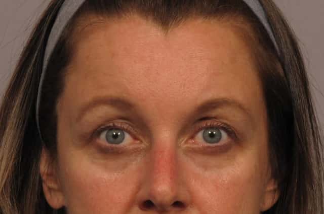 Front View, Eyes and Brow Lift, 6 months Post Op