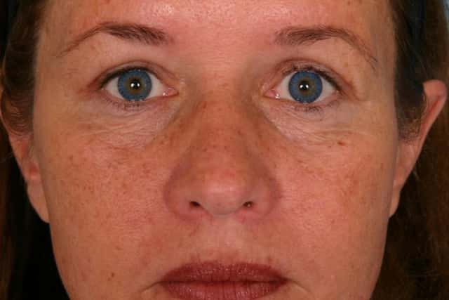 Eyelid Lift (Blepharoplasty) Before & After Case 51 after