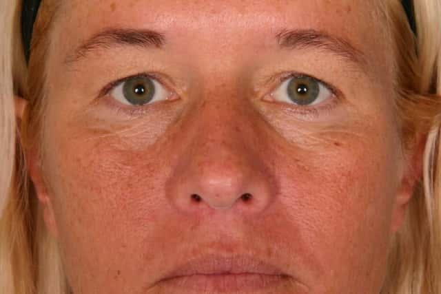 Eyelid Lift (Blepharoplasty) Before & After Case 51 before