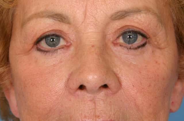 Eyelid Lift (Blepharoplasty) Before & After Case 52 after
