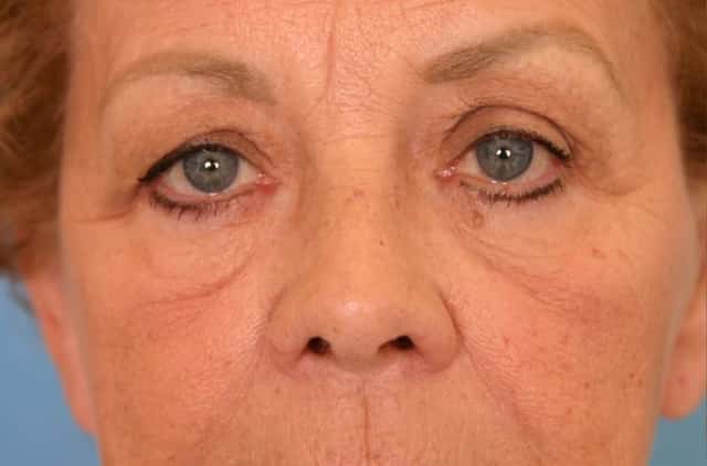 Eyelid Lift (Blepharoplasty) Before & After Case 52 before