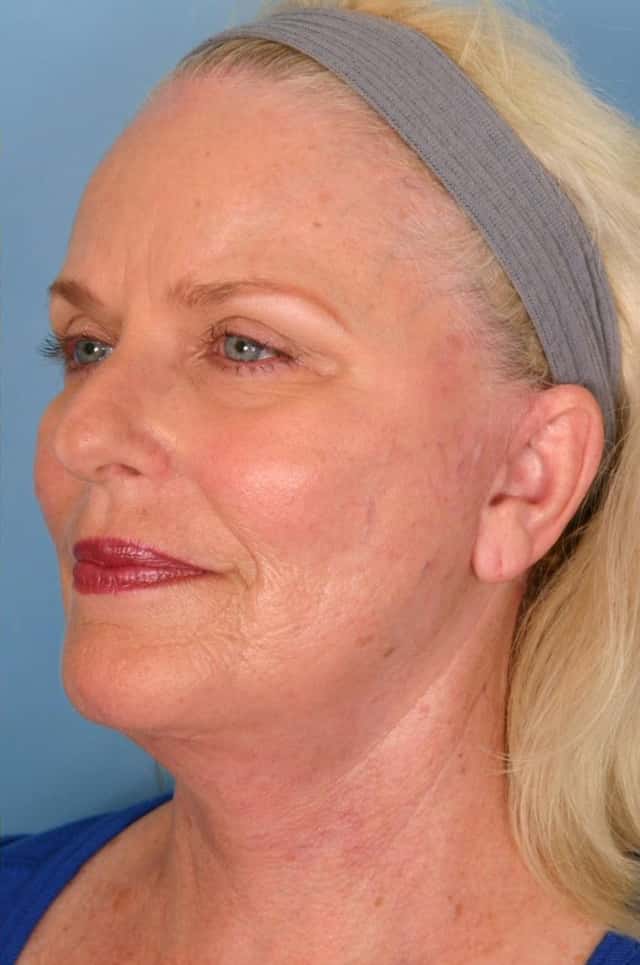 Facelift Before & After Case 10 after