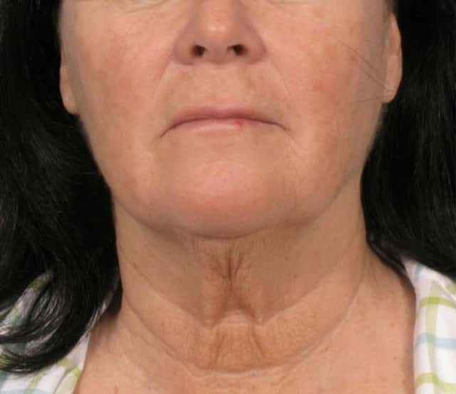 Facelift Before & After Case 109 before