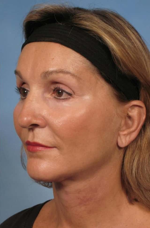 Facelift Before & After Case 110 after