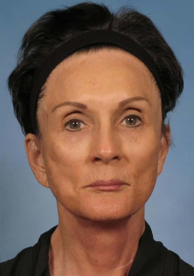 Facelift Before & After Case 142 after