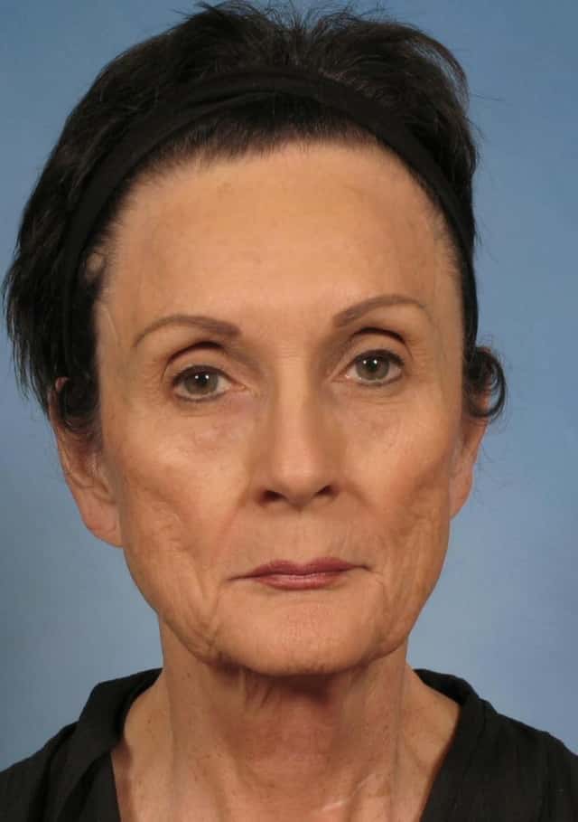 Facelift Before & After Case 142 before
