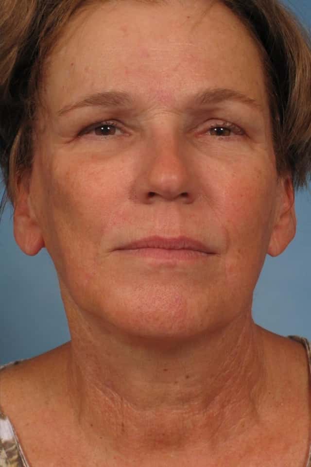 Facelift Before & After Case 165 after