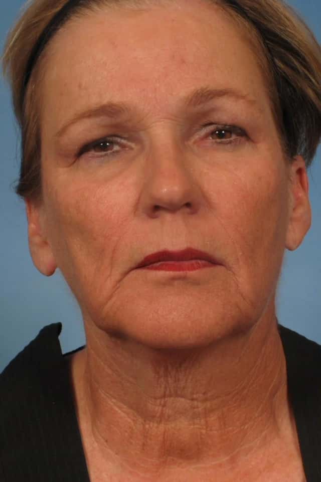 Facelift Before & After Case 165 before