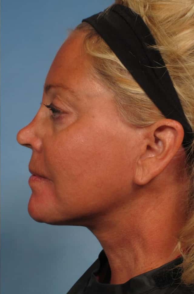 Facelift Before & After Case 166 after