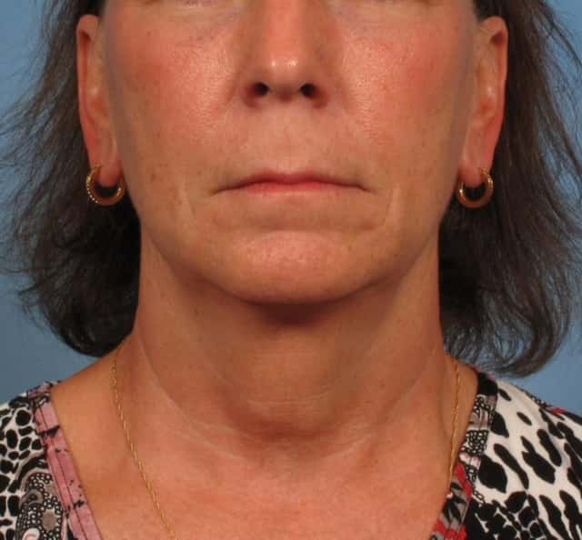 Facelift Before & After Case 180 before