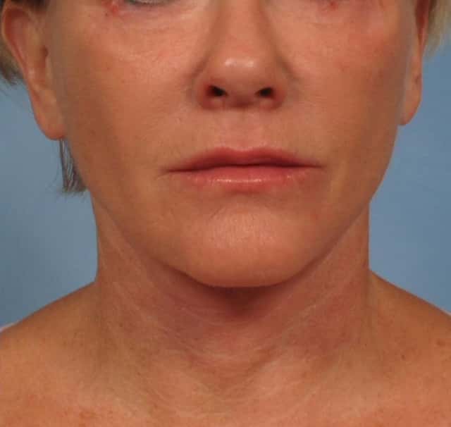 Facelift Before & After Case 181 after