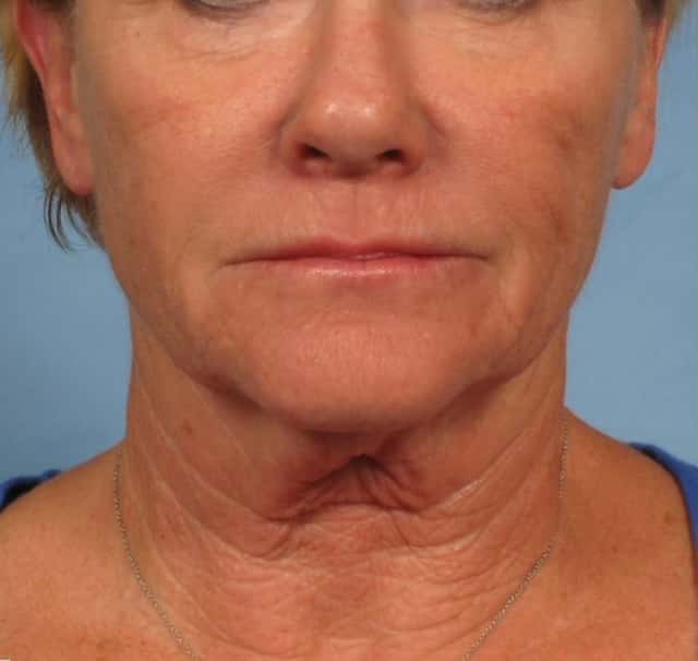 Facelift Before & After Case 181 before