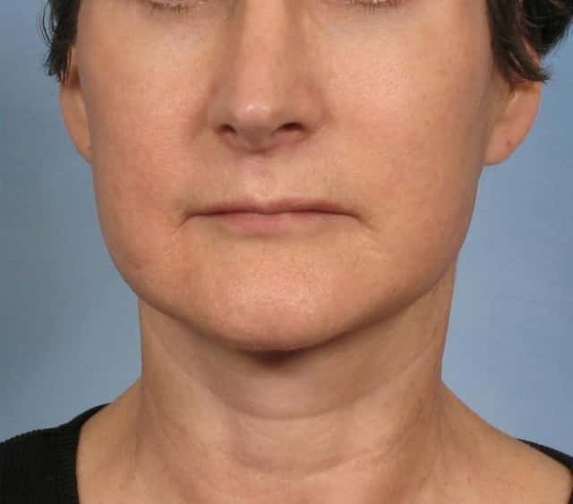 Facelift Before & After Case 182 after