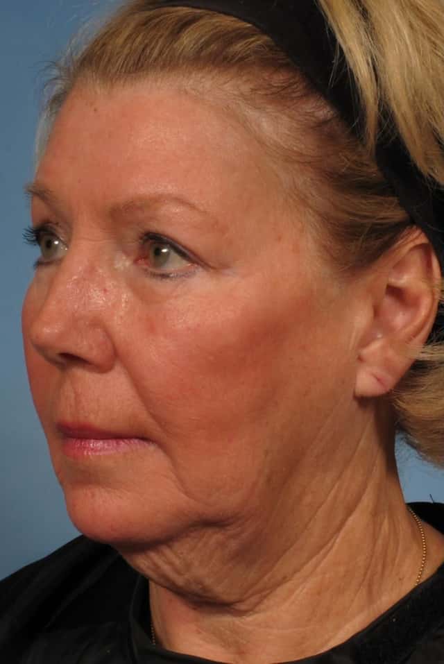 Facelift Before & After Case 183 before
