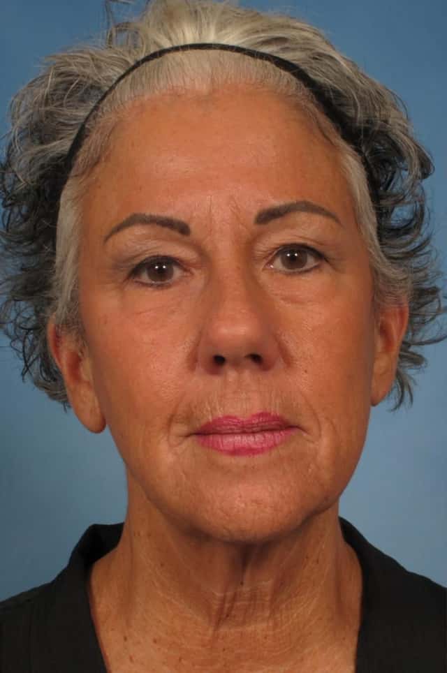 Facelift Before & After Case 185 before