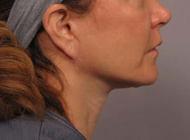 Facelift Before & After Case 300 after
