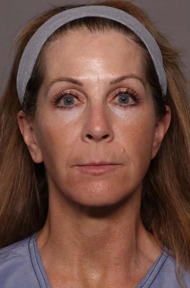 Before and 1 year After Facelift and Brow Lift by Dr. Kent Hasen of Naples, Florida