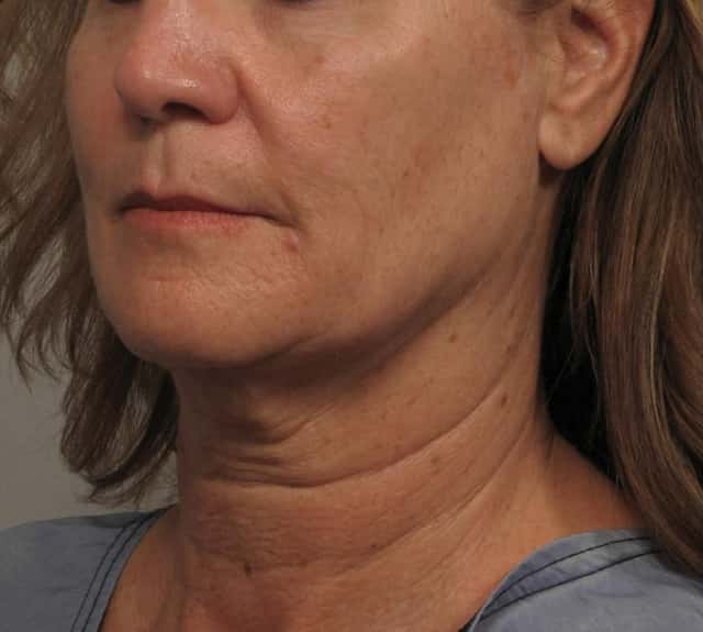 Facelift, Before and After Photos, Left Oblique by Dr. Kent V. Hasen