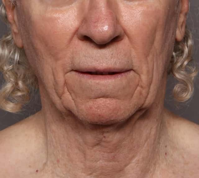 Facelift, Before and After at 3 Months, Frontal View, by Dr. Kent V. Hasen