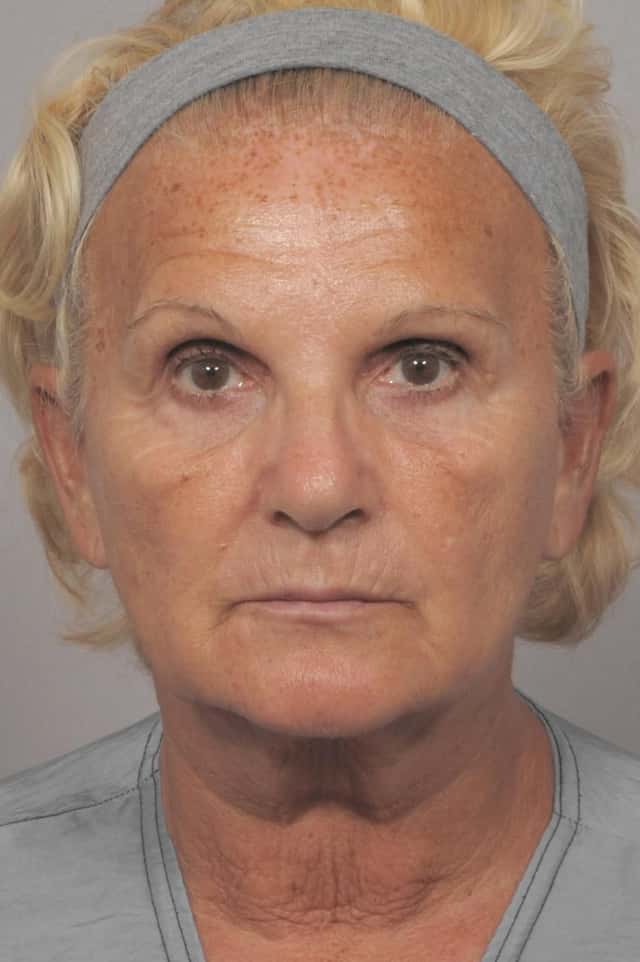 Facelift, Browlift and Fat Grafting, Before and After Photos, 1 Year Post Op, Frontal View by Dr. Kent Hasen