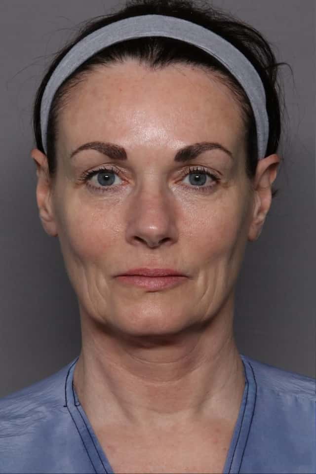 Facelift Before & After Case 438 before