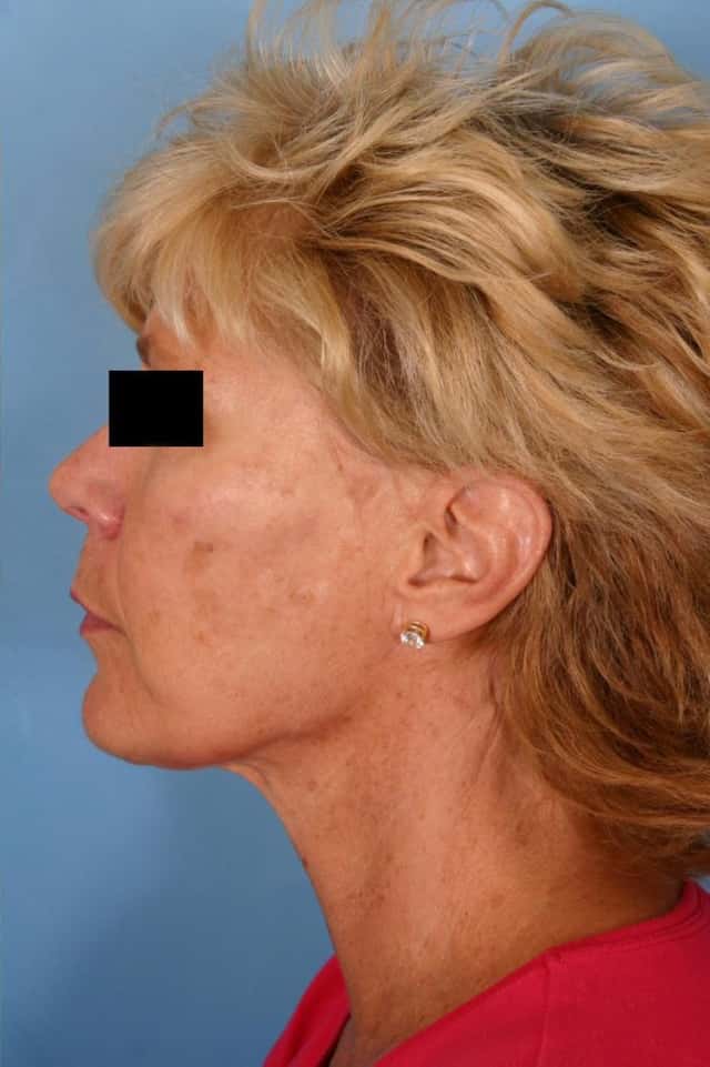 Facelift Before & After Case 8 after