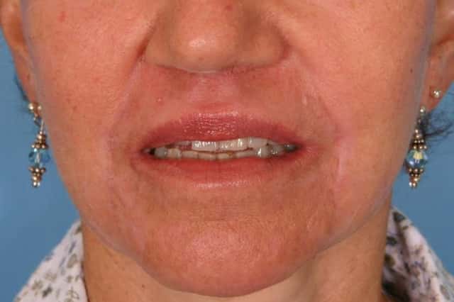 Fat Injections Before & After Case 24 after