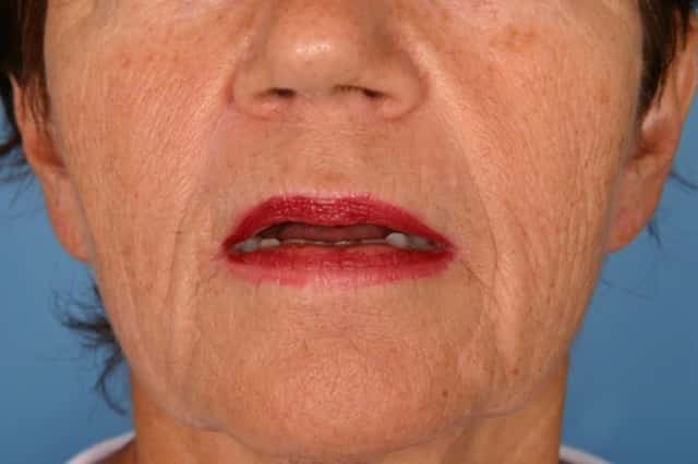 Fat Injections Before & After Case 24 before