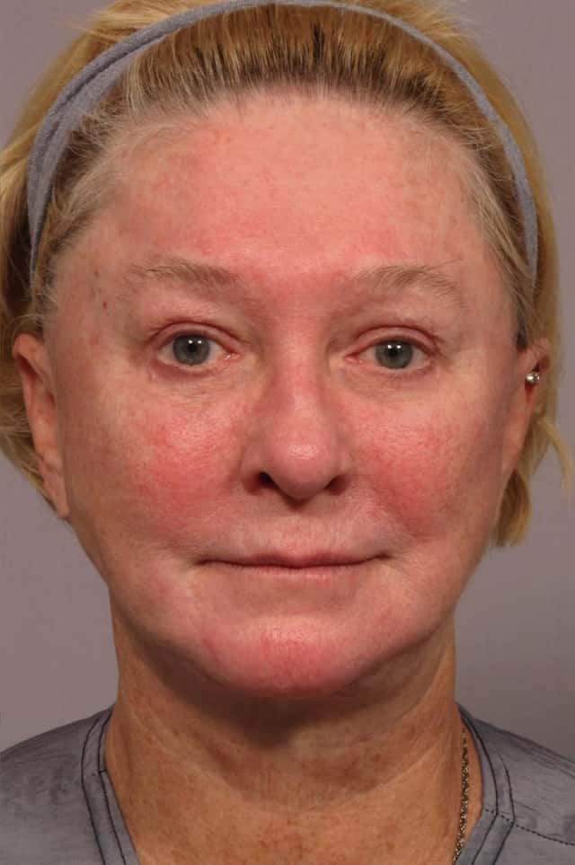 Fat Injections Before & After Case 299 after