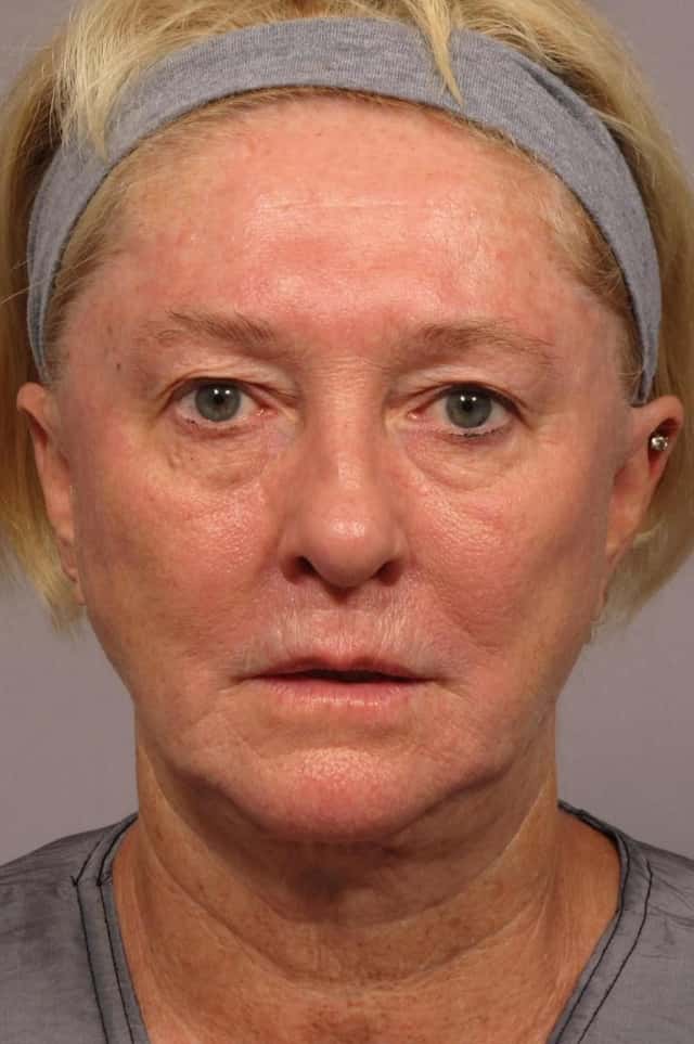 Fat Injections Before & After Case 299 before